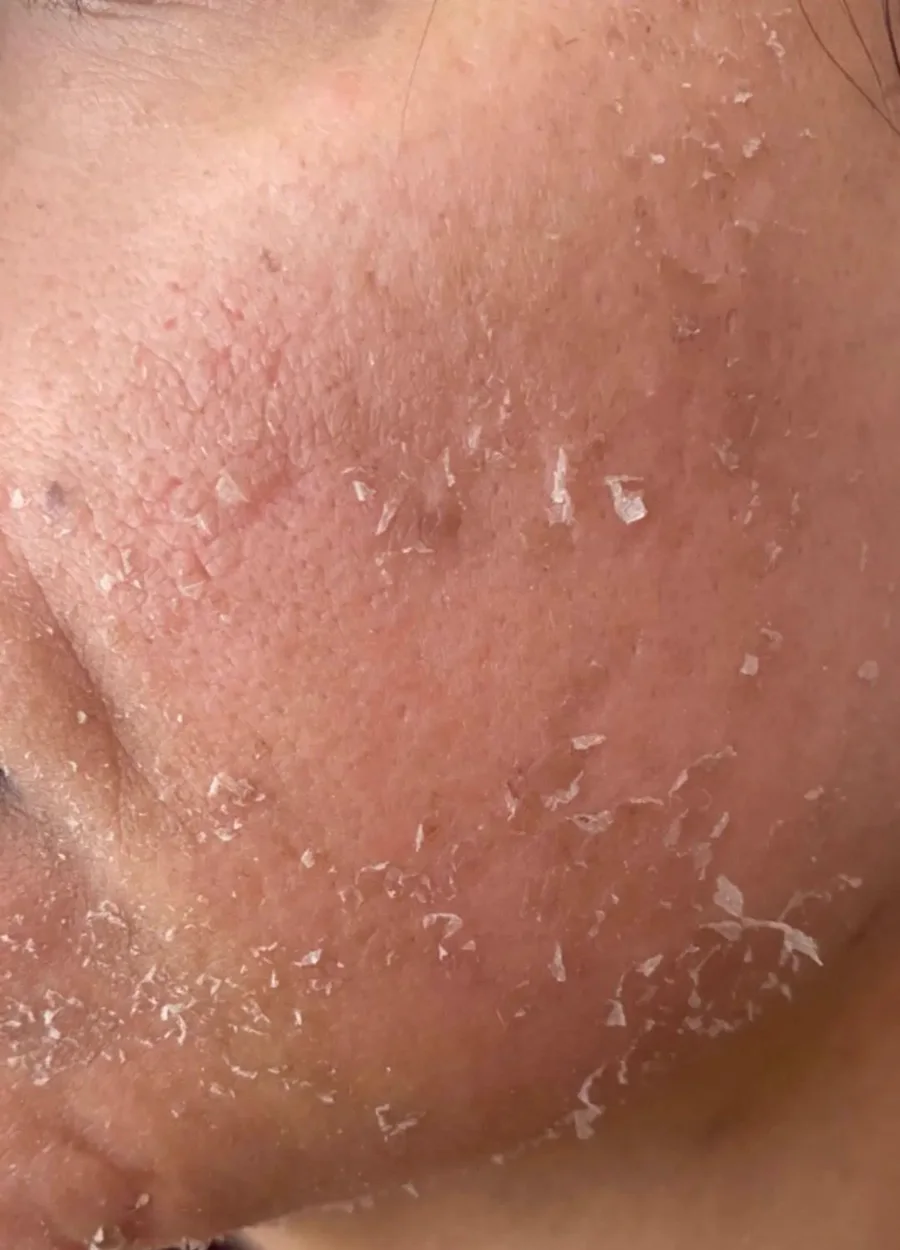 Yosun peeling sonrası cilt yenilenmesi